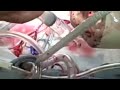 Bypass Surgery