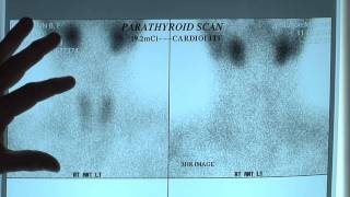 The Importance Of Sestamibi Scans For Parathyroid Tumors