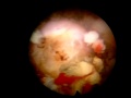 Lateral Transforaminal Endoscopic Spinal Decompression of my S1/L5 level video #1