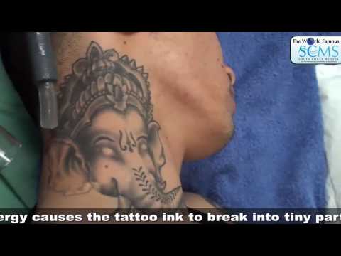 LASER TATTOO REMOVAL COST. Although John had spent thousands of dollars on 