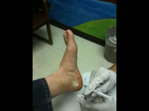Steroid injection plantar fasciitis side effects