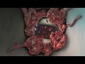 INCREDIBLE Nucleus Medical Media 2011 Demo