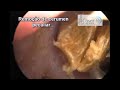 The Biggest Earwax removal by otoendoscopic technique ever??-A Maior cera de ouvido do mundo??