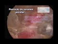 The Biggest Earwax removal by otoendoscopic technique ever??-A Maior cera de ouvido do mundo??