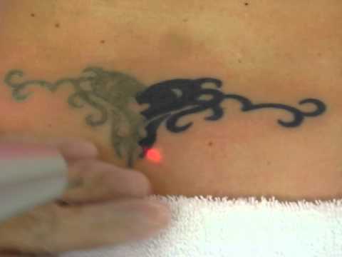 Laser Tattoo Removal happymmm 167324 views