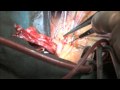 Heart Bypass Surgery Explained Part2
