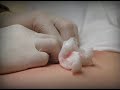 BIGGEST CYST ON THE PLANET | Operation