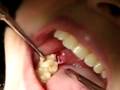 Wisdom Tooth Extraction