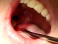 Wisdom Tooth Extraction