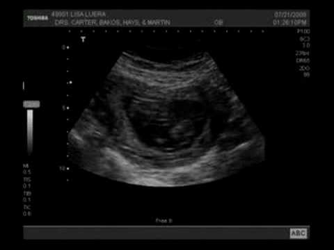 11 weeks pregnant. Sonogram 11 weeks pregnant