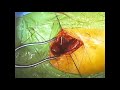 Total Hip Replacement - Surgical Procedure - HD