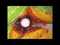 Total Hip Replacement - Surgical Procedure - HD