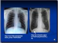 Chest x-ray interpretation --COPD and Emphysema
