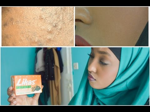 Comme prévenir la pigmentation sur la personne