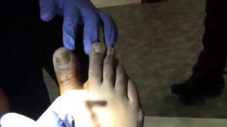 Toe Nail Removal for Onychomycosis lmellick 15,009 views 10 months ago In