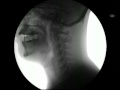 My X Ray swallows