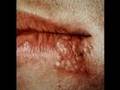 Cold Sore Information and Treatment