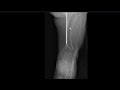 Paediatric MSK