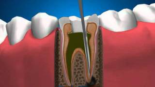 Периодонтит зубов и его лечение