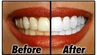 Dientes 4 TONOS más BLANCOS en CASA /Whiten your TEETH AT HOME whiteninglightning review