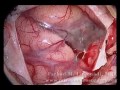 Brain surgery removal of metastatic tumor high power surgical microscope