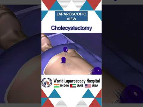 Laparoscopic Cholecystectomy #worldlaparoscopyhospital #minimalaccesssurgery #laparoscopy