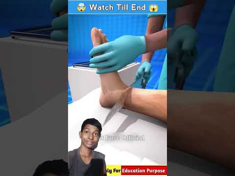 THE WRONG FOOT AMPUTATION (EXPLAIN IT 3D ANIMATION) #facts #3danimation #animation #cartoon #doctor