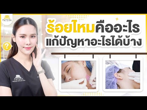 Patcha clinic ร้อยไหมคืออะไรควรร้อยกี่เส้นร้อยไปแล้วอาจะมีผลข้างเคียงอะไรบ