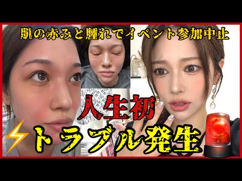 【肌トラブル発生⚠️】顔が赤く腫れてとんでもないことに…😭💔