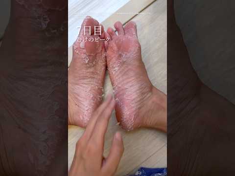 【閲覧注意】足の皮ずるむけ快感♡ベビーフットやってみた結果…