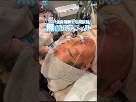 無痛ニキビ跡治療💉🤍 #ポテンツァ #トライフィルプロ #ニキビ跡 #クレーター #全身麻酔 #shorts