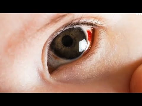 Factores del traumatismo ocular
