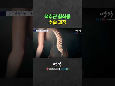척추관 협착증 수술은 어떻게 할까?
