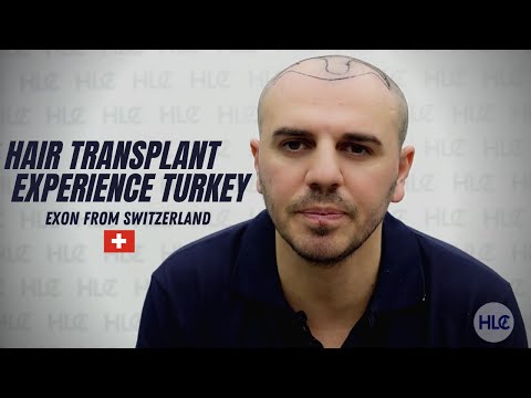 Haartransplantation Türkei , Erfahrungen HLC, Haartransplantation vorher nachher