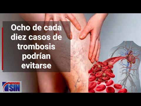 Ocho de cada diez casos de trombosis podrían evitarse