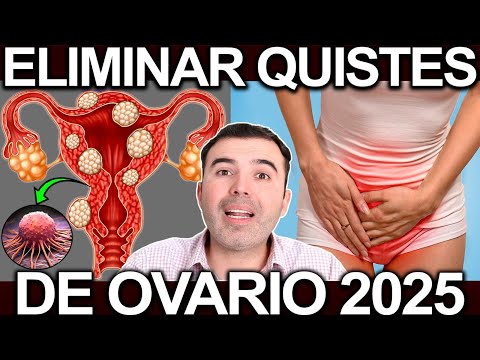 COMO ELIMINAR LOS QUISTES DE OVARIO 2025