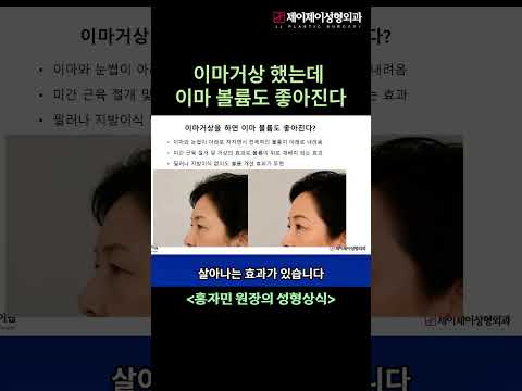 이마거상 했는데 이마 볼륨도 좋아진다?#이마거상