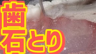 作業用　歯石取り