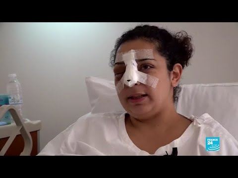 Líbano: a un mes de la explosión, heridos se someten a reconstrucciones faciales