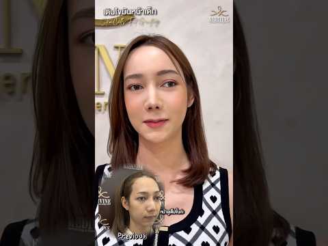 Medivine Clinic เมดิไวน์ คลินิก ฉีดไขมันหน้าเด็กลูกสาวหมอฟู่ปรับรูปหน้าให้ได้สัดส่วนสวยละมุน