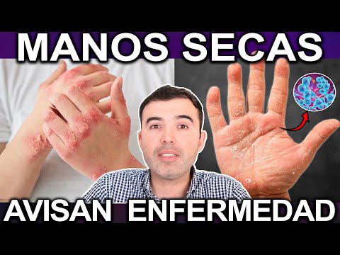 PIEL SECA! Tu Cuerpo Te Está Avisando Causas Enfermedades  Tratamientos Para Eliminar La Piel Reseca