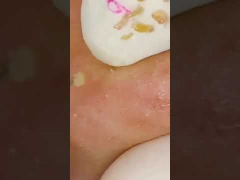 BIBO TH Squeezeacne🤟บีบสิวتلميعوتنظيفالجلدالطبيعيالمدور