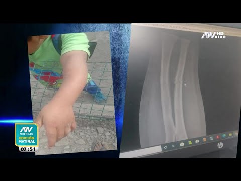 Madre denuncia negligencia médica luego de que enyesaran el brazo a su hijo y se lo dejaran torcido