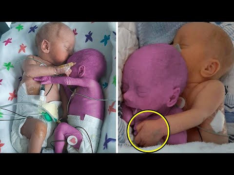 Krankenschwester legt gesundes Baby neben sterbenden Zwilling. Was geschah, macht jeden sprachlos