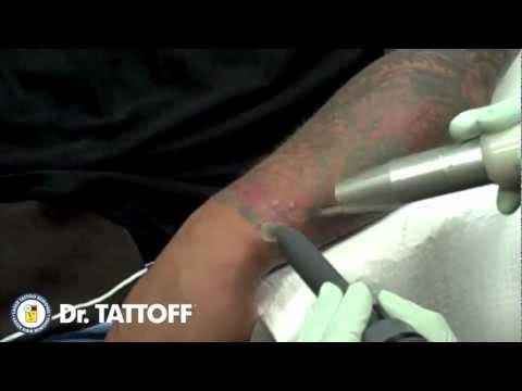 download youtube mp3 tattoo removal laser tattoo removal download youtube mp3 tattoo removal laser tattoo removal