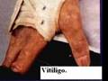 Michael Jackson and Vitiligo