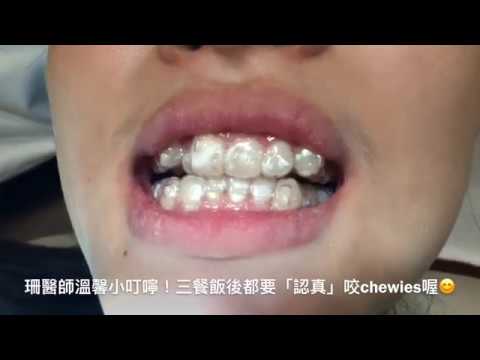 【隱形矯正全攻略】如何正確配戴及取下隱形牙套 — Dr. 珊 隱形矯正專家