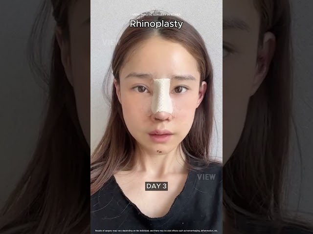Rhinoplasty Journey 👃🏻#nosejob #rhinoplasty #korea #surgery #journey #nosereshape