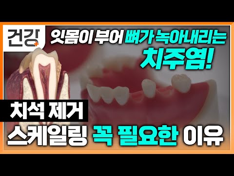 제때 스케일링만 잘 받아도 예방할 수 있는 임플란트와 틀니 | 8020 치아 건강 지킴이 | 명의 | EBS 건강