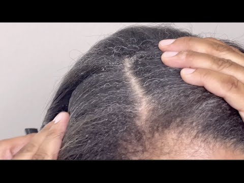 Dandruff Scratching | More Big Flakes!! Pt 3of3
